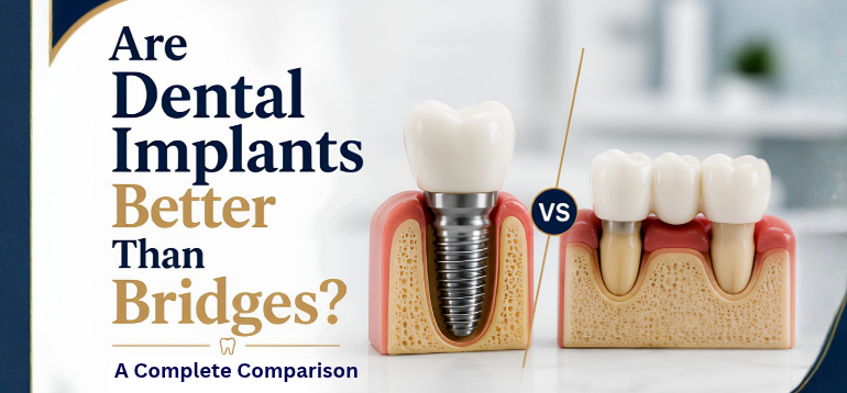 Are Dental Implants Better Than Bridges? A Complete Comparison  