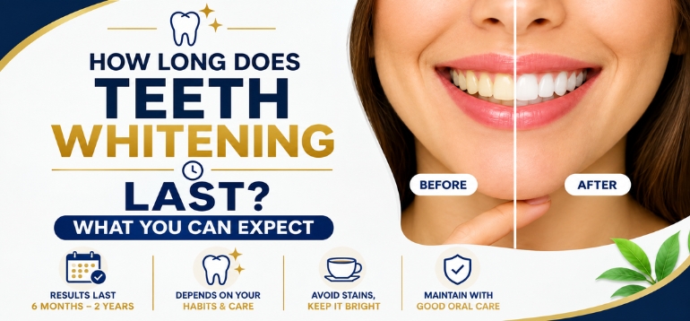How Long Does Teeth Whitening Last? What You Can Expect 