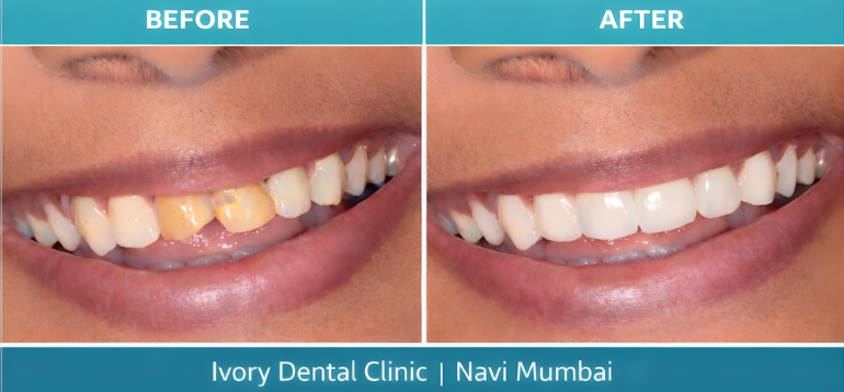 Smile Makeover in Navi Mumbai for Discolored Front Teeth