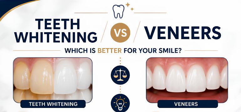 Teeth Whitening vs Veneers: Which Is Better for Your Smile?  